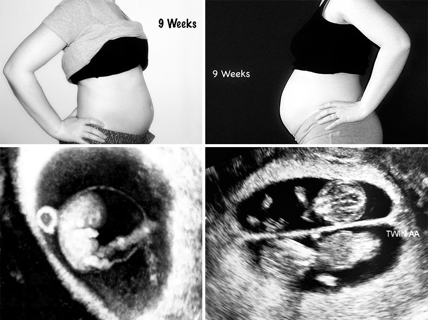 Twin Pregnancy Week by Week: What's Actually Different From Singletons